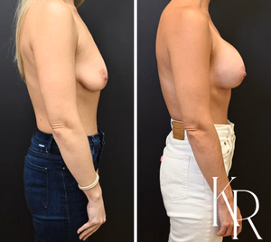 Breast lift with implants before and after photo, side view