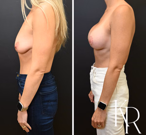 Breast lift with implants before and after photo, side view