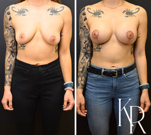 Breast lift with implants before and after photo, front view