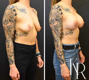Breast lift with implants before and after photo, front view