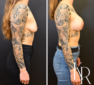 Breast lift with implants before and after photo, side view