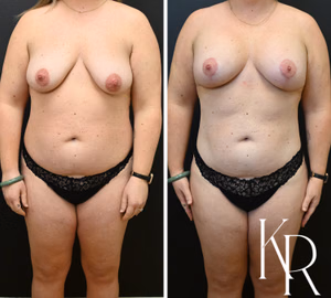 Breast lift with implants before and after photo, front view