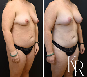 Breast lift with implants before and after photo, front view