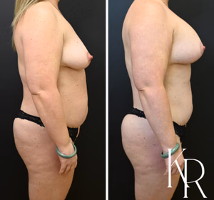 Breast lift with implants before and after photo, side view