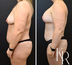 Breast lift with implants before and after photo, side view