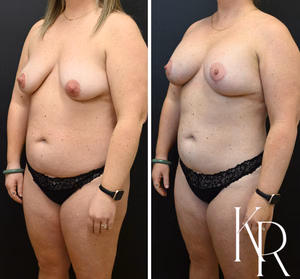 Breast lift with implants before and after photo, front view