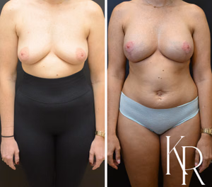 Breast lift with implants before and after photo, front view