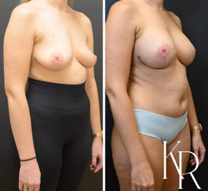 Breast lift with implants before and after photo, front view