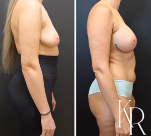 Breast lift with implants before and after photo, side view