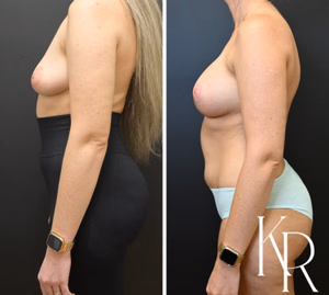 Breast lift with implants before and after photo, side view