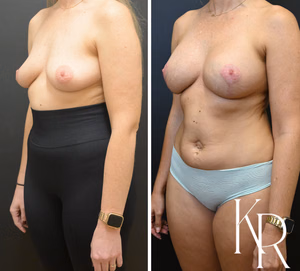 Breast lift with implants before and after photo, front view