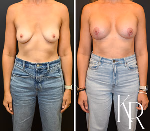 Breast lift with implants before and after photo, front view