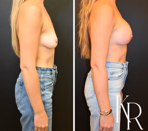 Breast lift with implants before and after photo, side view