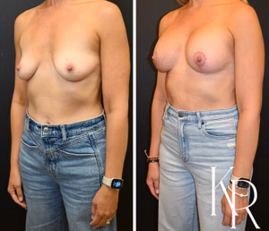 Breast lift with implants before and after photo, front view