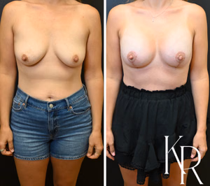 Breast lift with implants before and after photo, front view