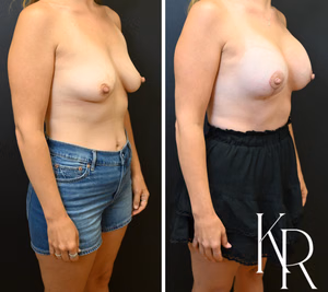 Breast lift with implants before and after photo, front view