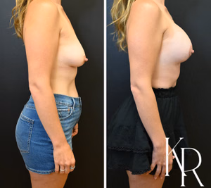 Breast lift with implants before and after photo, side view