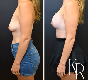 Breast lift with implants before and after photo, side view