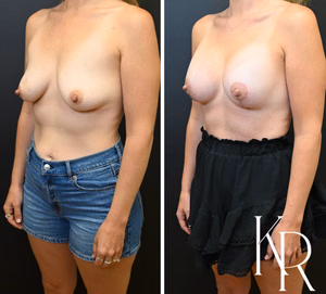 Breast lift with implants before and after photo, front view