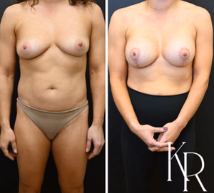 Breast lift with implants before and after photo, front view