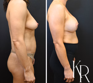 Breast lift with implants before and after photo, side view