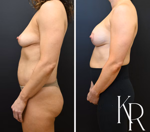 Breast lift with implants before and after photo, side view