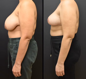 Breast reduction before and after photo, side view
