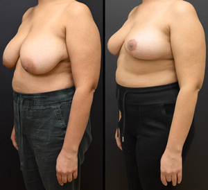 Breast reduction before and after photo, front view