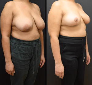 Breast reduction before and after photo, front view