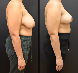 Breast reduction before and after photo, side view