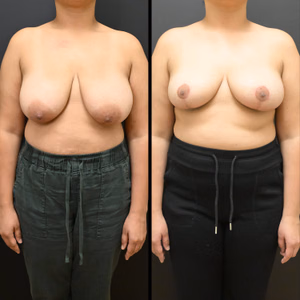 Breast reduction before and after photo, front view
