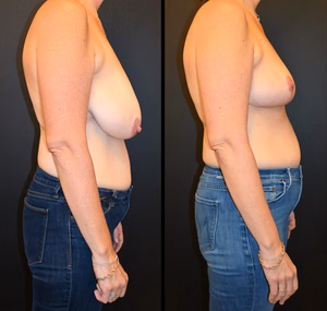 Breast reduction before and after photo, side view