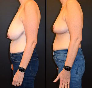 Breast reduction before and after photo, side view