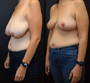 Breast reduction before and after photo, front view