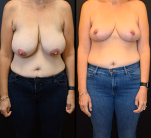 Breast reduction before and after photo, front view