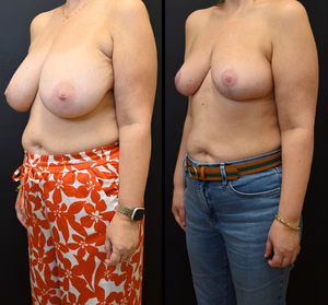 Breast reduction before and after photo, front view