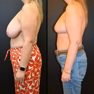 Breast reduction before and after photo, side view