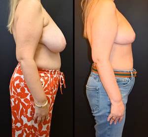 Breast reduction before and after photo, multiple views