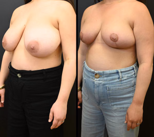 Breast reduction before and after photo, front view