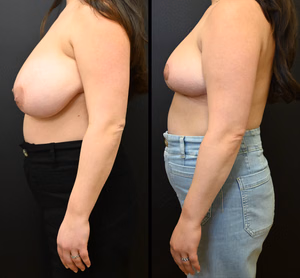 Breast reduction before and after photo, side view