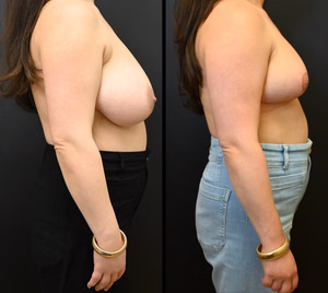 Breast reduction before and after photo, multiple views