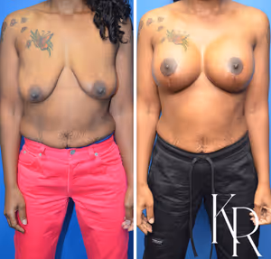 Breast lift with implants before and after photo, front view