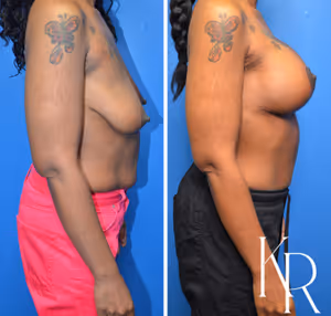 Breast lift with implants before and after photo, side view
