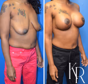 Breast lift with implants before and after photo, front view