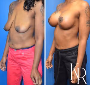 Breast lift with implants before and after photo, front view