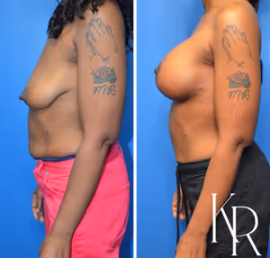 Breast lift with implants before and after photo, side view
