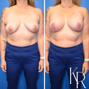 Breast lift with implants before and after photo, front view