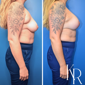 Breast lift with implants before and after photo, side view
