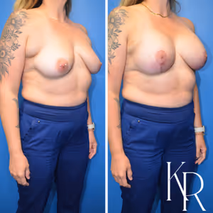 Breast lift with implants before and after photo, front view