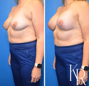 Breast lift with implants before and after photo, front view